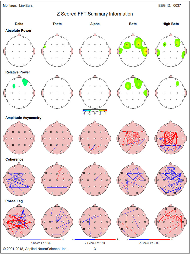 Figure 9 - Baseline eyes-open NeuroGuide z-score FFT summary report